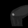 SPORK, NICO - 22.03.1976 - 02.08.2022 - CT obere Extremität - 17:59:07